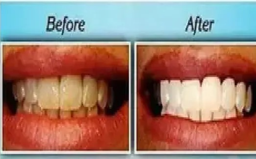 Blanqueador Dental 20 Minutos